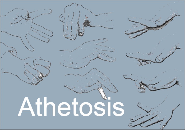 athetosis cause